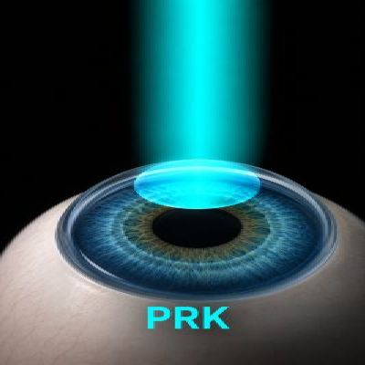 Standard PRK Surgery